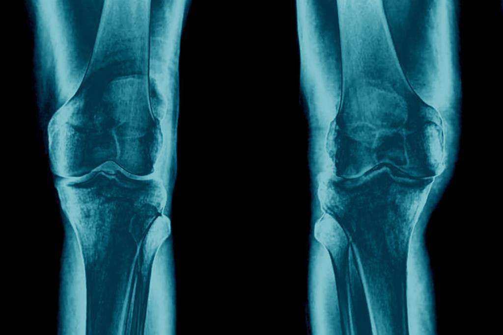 a deformáló arthrosis kezdeti szakasza